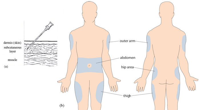 TECHNIQUES FOR ADMINISTERING INSULIN INJECTION NURSES IN GHANA   Injection Sites For Insulin 