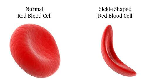 SICKLE CELL ANEMIA – CLINICAL MANIFESTATIONS